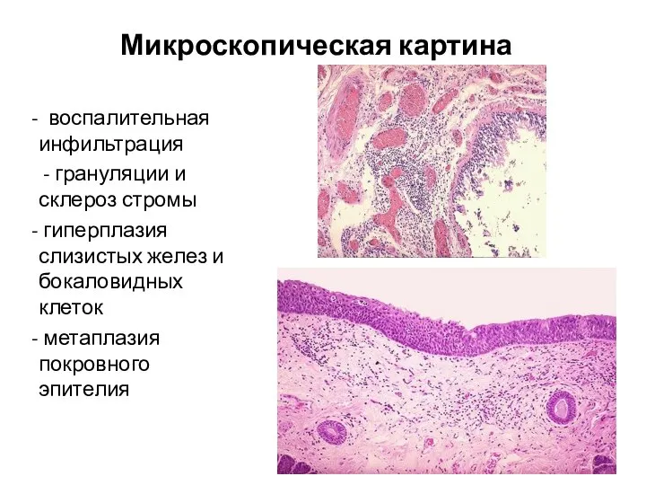 Микроскопическая картина воспалительная инфильтрация - грануляции и склероз стромы гиперплазия слизистых