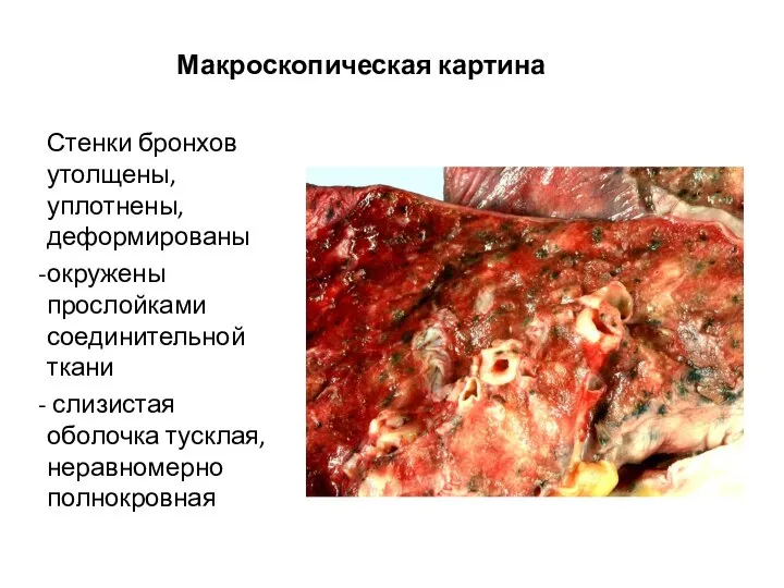 Макроскопическая картина Стенки бронхов утолщены, уплотнены, деформированы окружены прослойками соединительной ткани слизистая оболочка тусклая, неравномерно полнокровная