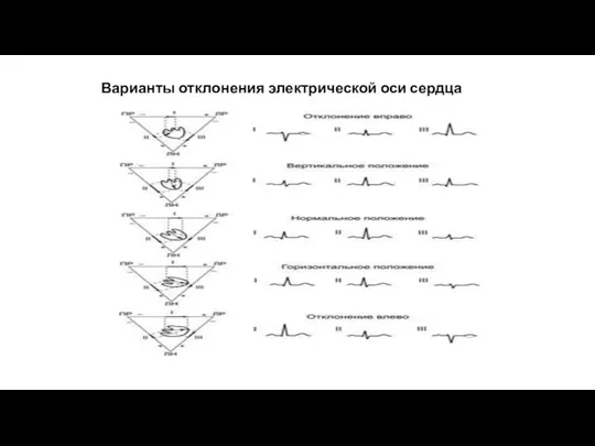 Варианты отклонения электрической оси сердца