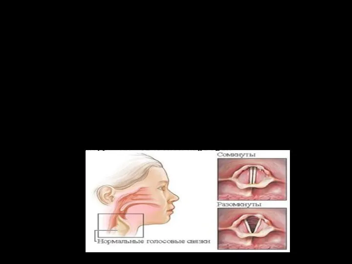Заболевания голосовых связок. Любые болезни способны вывести человека из строя. А
