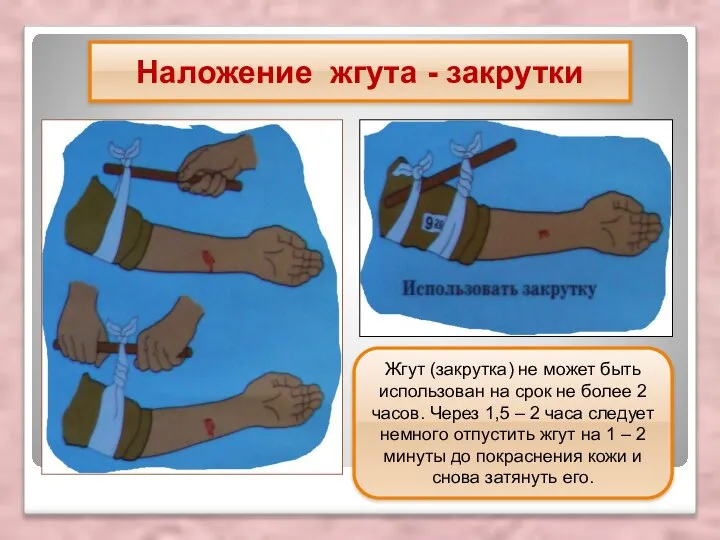 Наложение жгута - закрутки Жгут (закрутка) не может быть использован на