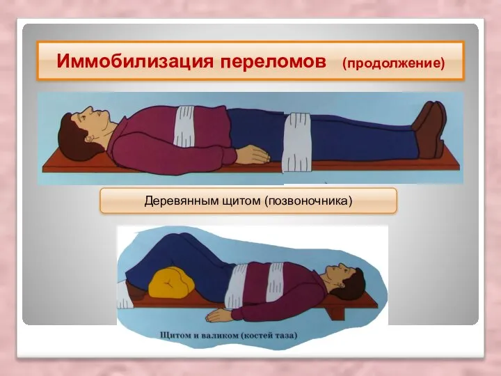 Иммобилизация переломов (продолжение) Деревянным щитом (позвоночника)