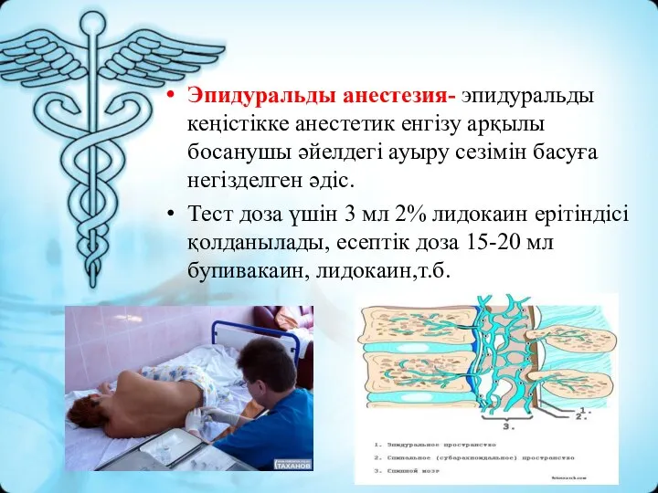 Эпидуральды анестезия- эпидуральды кеңістікке анестетик енгізу арқылы босанушы әйелдегі ауыру сезімін