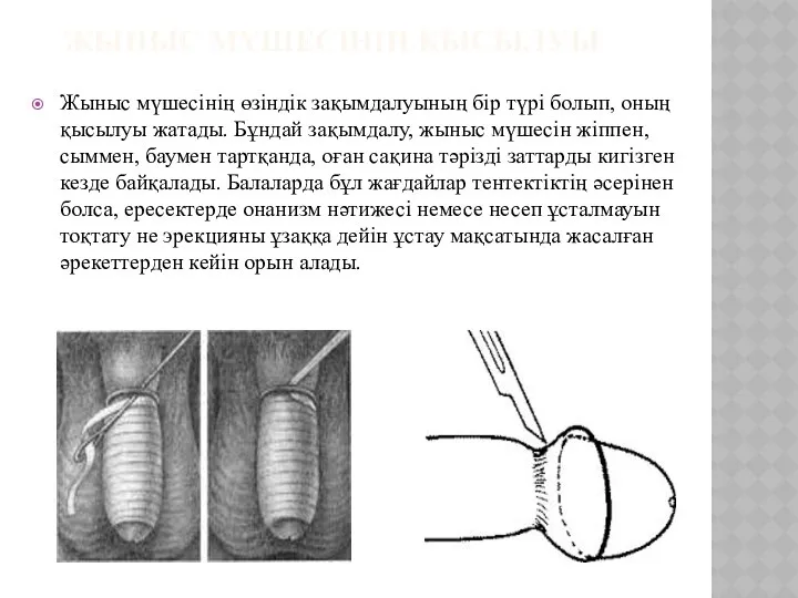 ЖЫНЫС МҮШЕСІНІҢ ҚЫСЫЛУЫ Жыныс мүшесінің өзіндік зақымдалуының бір түрі болып, оның