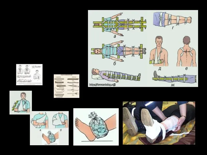 Иммобилизация при помощи подручных средств: а, б - при переломе позвоночника;