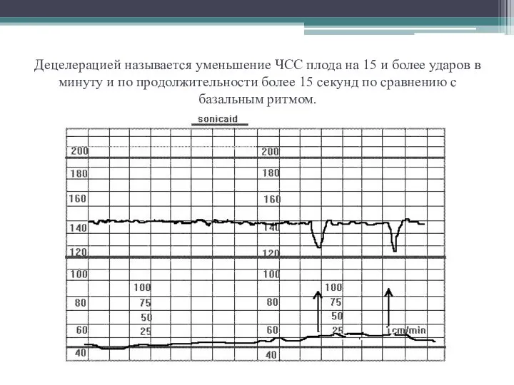 Децелерацией называется уменьшение ЧСС плода на 15 и более ударов в