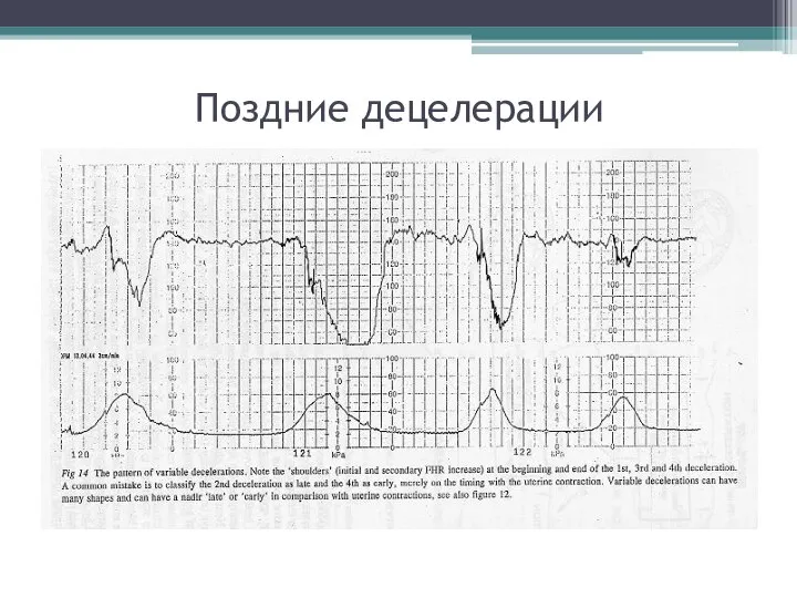 Поздние децелерации