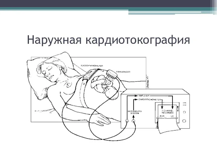 Наружная кардиотокография