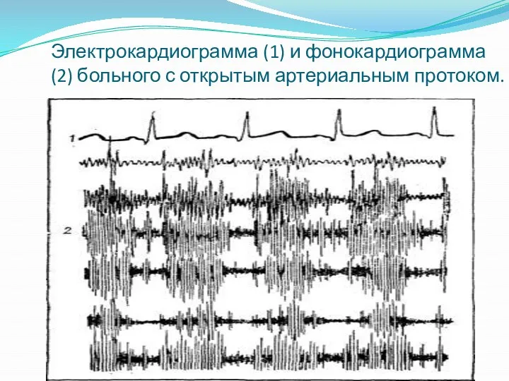 Электрокардиограмма (1) и фонокардиограмма (2) больного с открытым артериальным протоком.