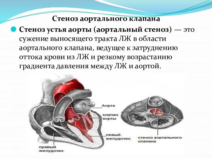 Стеноз аортального клапана Стеноз устья аорты (аортальный стеноз) — это сужение
