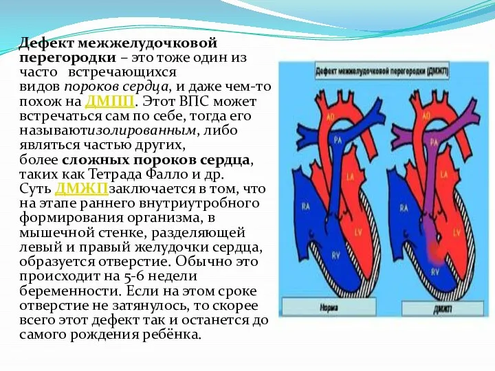 Дефект межжелудочковой перегородки – это тоже один из часто встречающихся видов