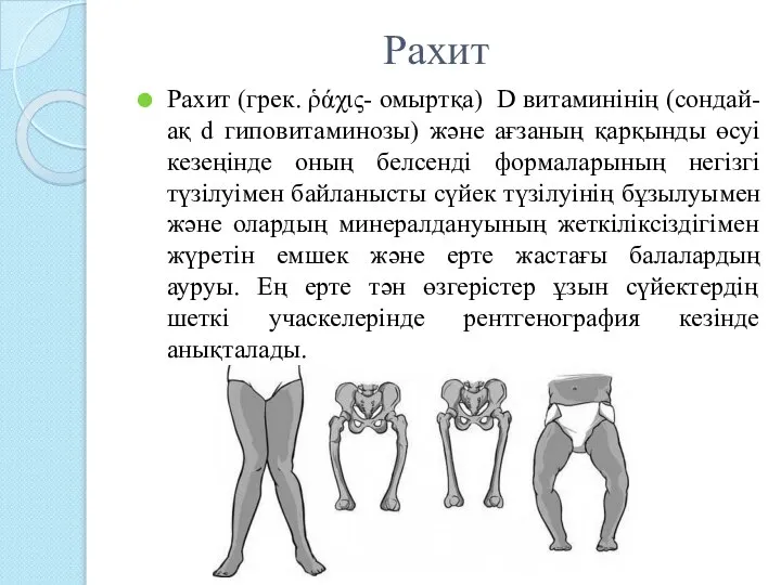 Рахит Рахит (грек. ῥάχις- омыртқа) D витаминінің (сондай-ақ d гиповитаминозы) және