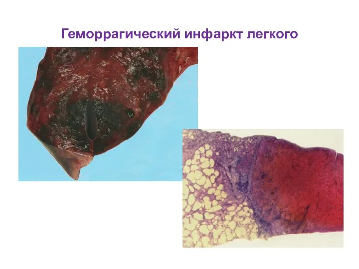 Геморрагический инфаркт легкого