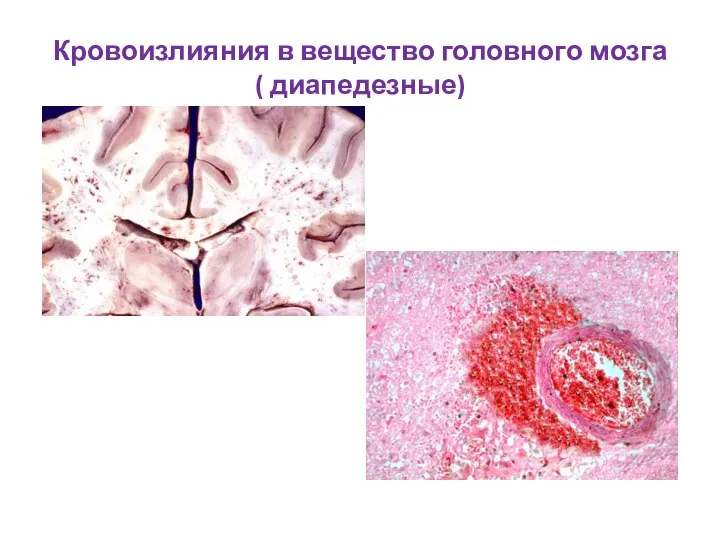 Кровоизлияния в вещество головного мозга ( диапедезные)