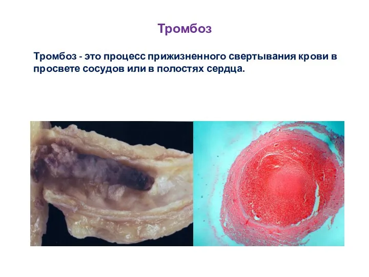 Тромбоз Тромбоз - это процесс прижизненного свертывания крови в просвете сосудов или в полостях сердца.