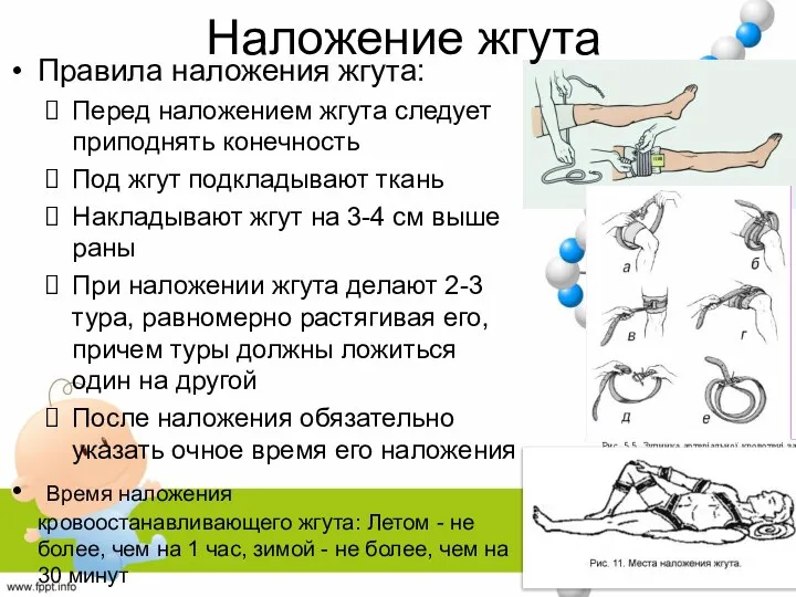 Наложение жгута Правила наложения жгута: Перед наложением жгута следует приподнять конечность