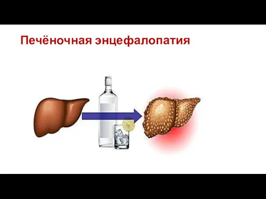 Печёночная энцефалопатия