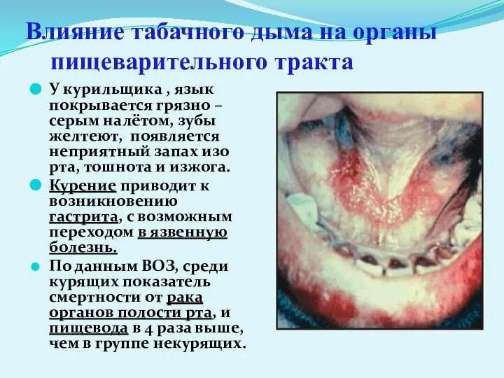 Влияние табачного дыма на органы пищеварительного тракта У курильщика , язык