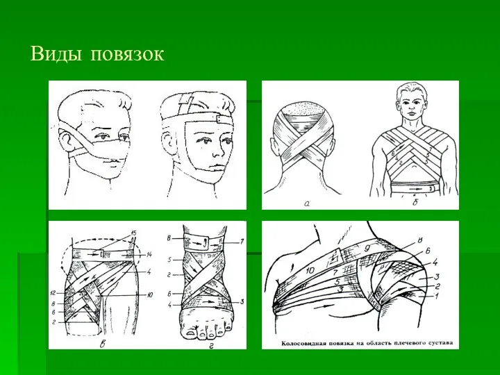 Виды повязок