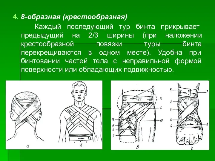 4. 8-образная (крестообразная) Каждый последующий тур бинта прикрывает предыдущий на 2/3