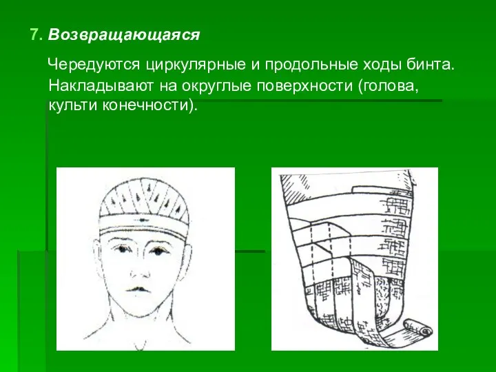 7. Возвращающаяся Чередуются циркулярные и продольные ходы бинта. Накладывают на округлые поверхности (голова, культи конечности).