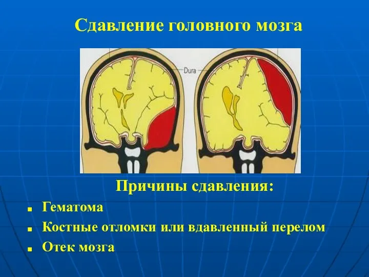 Сдавление головного мозга Причины сдавления: Гематома Костные отломки или вдавленный перелом Отек мозга