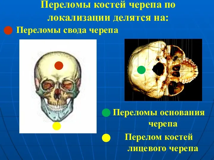 Переломы костей черепа по локализации делятся на: Переломы свода черепа Переломы