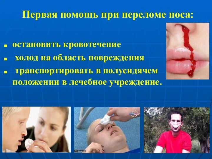 Первая помощь при переломе носа: остановить кровотечение холод на область повреждения