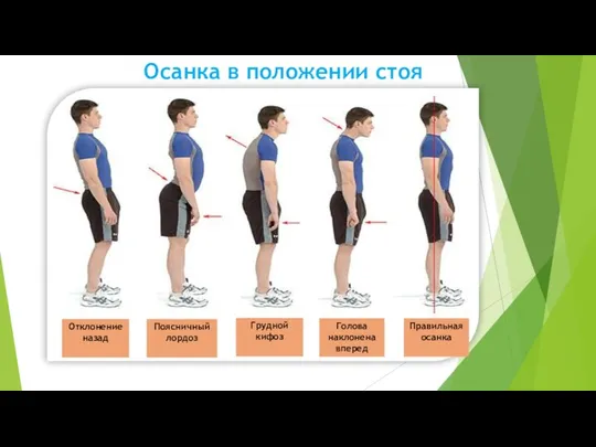 Осанка в положении стоя Отклонение назад Поясничный лордоз Грудной кифоз Голова наклонена вперед Правильная осанка