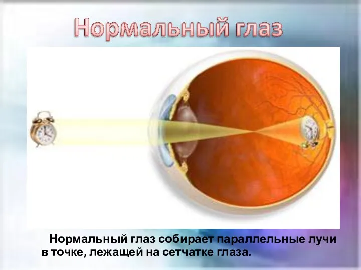 Нормальный глаз собирает параллельные лучи в точке, лежащей на сетчатке глаза.