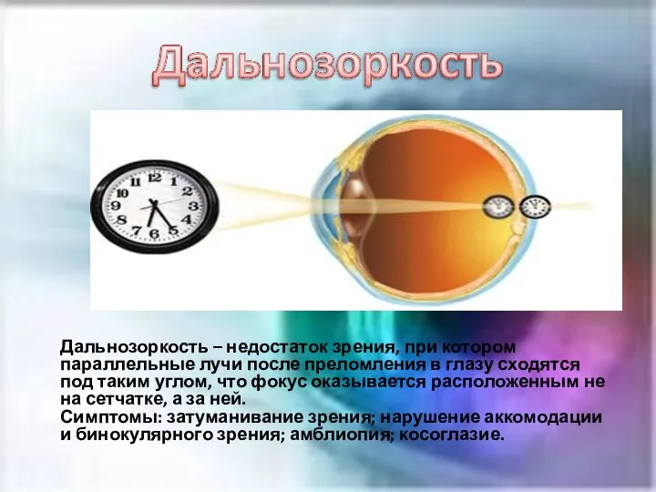 Дальнозоркость – недостаток зрения, при котором параллельные лучи после преломления в