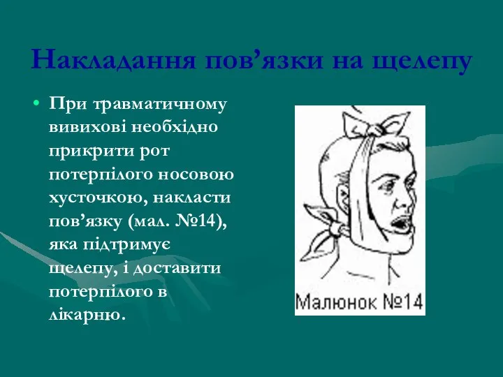 Накладання пов’язки на щелепу При травматичному вивихові необхідно прикрити рот потерпілого
