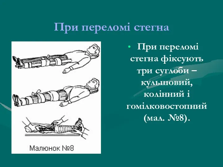 При переломі стегна При переломі стегна фіксують три суглоби – кульшовий, колінний і гомілковостопний (мал. №8).