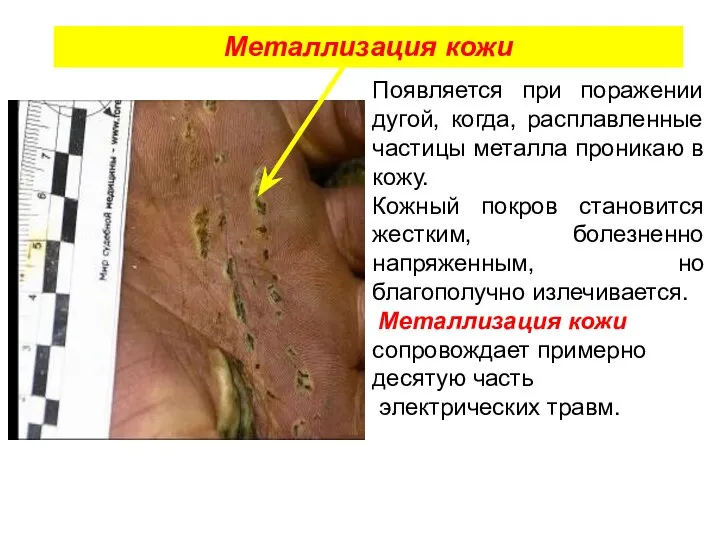 Появляется при поражении дугой, когда, расплавленные частицы металла проникаю в кожу.