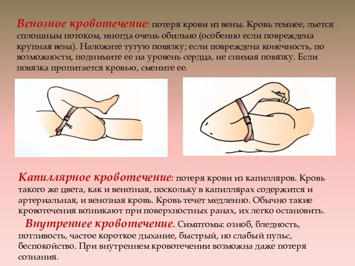 Венозное кровотечение: потеря крови из вены. Кровь темнее, льется сплошным потоком,