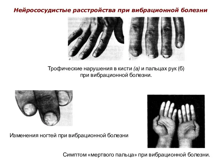 Трофические нарушения в кисти (а) и пальцах рук (б) при вибрационной