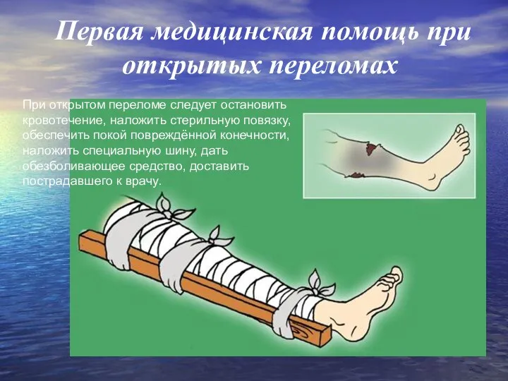 Первая медицинская помощь при открытых переломах При открытом переломе следует остановить