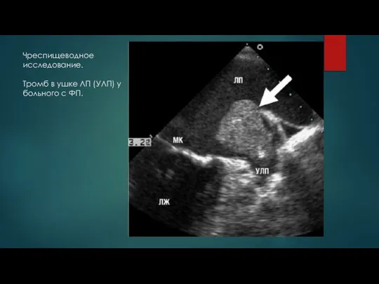 Чреспищеводное исследование. Тромб в ушке ЛП (УЛП) у больного с ФП.