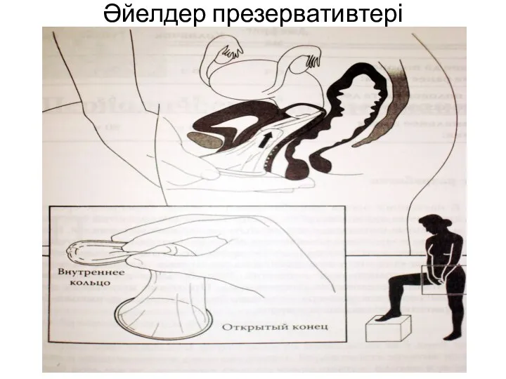 Әйелдер презервативтері