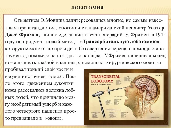 ЛОБОТОМИЯ Открытием Э.Мониша заинтересовались многие, но самым извес-тным пропагандистом лоботомии стал