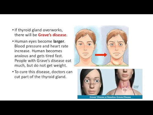 If thyroid gland overworks, there will be Grave’s disease. Human eyes