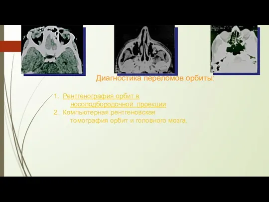 Диагностика переломов орбиты: Рентгенография орбит в носоподбородочной проекции Компьютерная рентгеновская томография орбит и головного мозга.