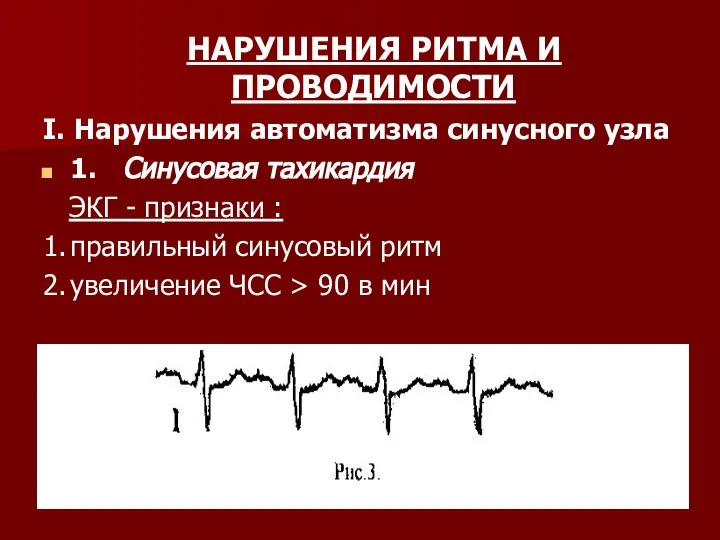 НАРУШЕНИЯ РИТМА И ПРОВОДИМОСТИ I. Нарушения автоматизма синусного узла 1. Синусовая