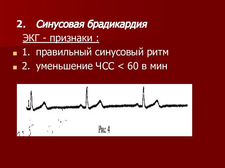 2. Синусовая брадикардия ЭКГ - признаки : 1. правильный синусовый ритм 2. уменьшение ЧСС