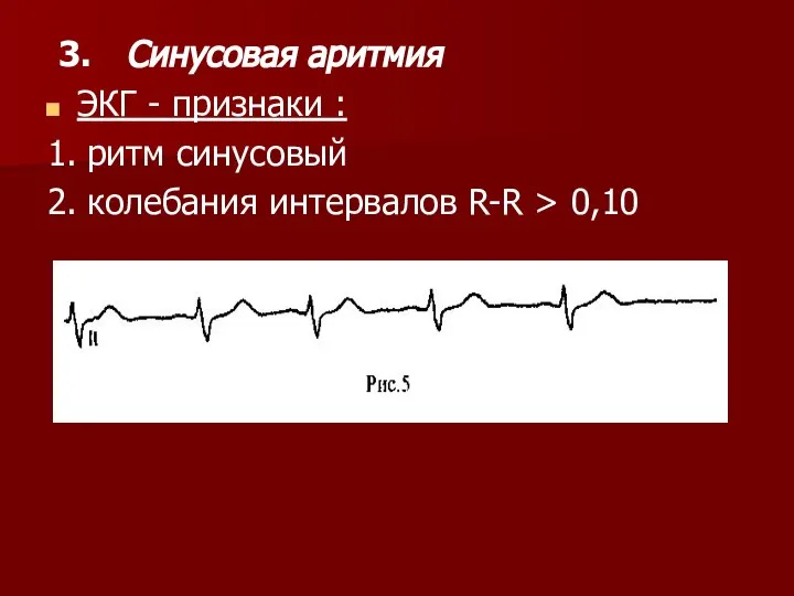 3. Синусовая аритмия ЭКГ - признаки : 1. ритм синусовый 2. колебания интервалов R-R > 0,10