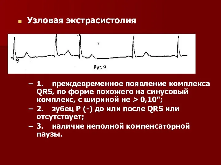 Узловая экстрасистолия 1. преждевременное появление комплекса QRS, по форме похожего на