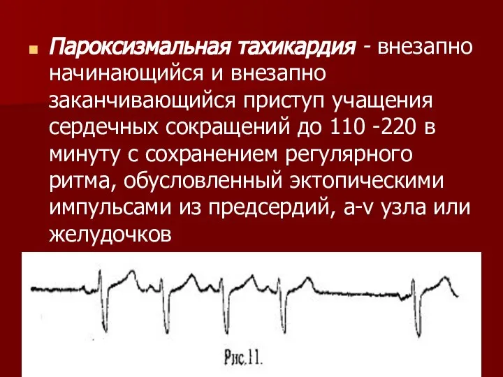 Пароксизмальная тахикардия - внезапно начинающийся и внезапно заканчивающийся приступ учащения сердечных