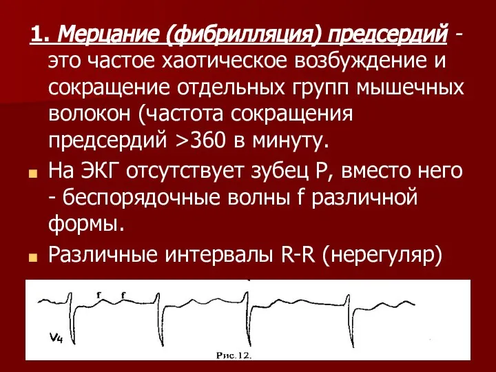 1. Мерцание (фибрилляция) предсердий - это частое хаотическое возбуждение и сокращение