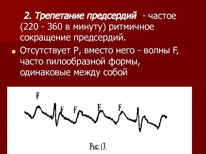 2. Трепетание предсердий - частое (220 - 360 в минуту) ритмичное