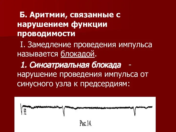 Б. Аритмии, связанные с нарушением функции проводимости I. Замедление проведения импульса